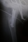 ortopedia  pediatrica- microcirugia del pie 