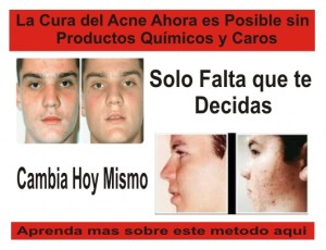 vick Avisos gratis en Mexico lindo en Texcoco |  Curar el acn&eacute; en casa, La Piel Grasa, Curar el acn&eacute; y sus cicatrices, Remedio f&aacute;cil para su acn&eacute;