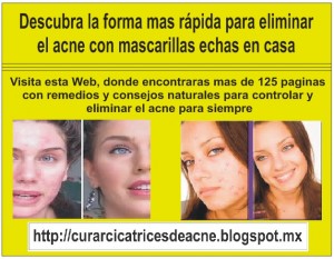 victor Avisos gratis en Mexico lindo en Texcoco |  Como quitar el acn&eacute; - para eliminar el acne del rostro, Como quitar el acn&eacute; - remedios caseros para el acne