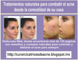 victor Avisos gratis en Mexico lindo en Texcoco |  Eliminar acn&eacute; rapidamente de la espalda para siempre, Solucion para el acne con remedios caseros