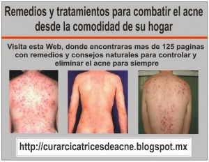 victor Avisos gratis en Mexico lindo en Texcoco |  Remedios para acn&eacute; - remedio para el acne , Remedios para el acne con ingredientes naturales