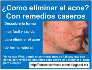 vic Avisos gratis en Mexico lindo en Texcoco |  Remedio para el acn&eacute; - acne de adolecente, Tratamientos y remedios para el acne de adolecente
