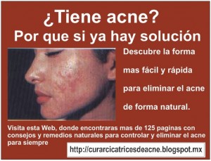 vic Avisos gratis en Mexico lindo en Texcoco |  Tratamiento para el acn&eacute; - solucion rapida para el acne, Lo mejor para el acne, barros y espinilas