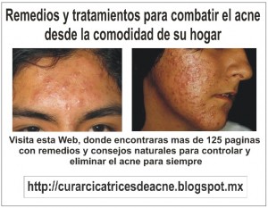 vic Avisos gratis en Mexico lindo en Texcoco |  Remedios caseros para el acn&eacute; solucion rapida y natural, Los mejores remedios para las cicatrices del acne