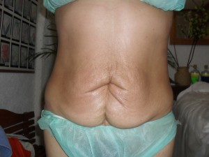 Carlos Alvarez C. Avisos gratis en Mexico lindo en Tlalpan |  Reduce grasa sin bisturi !!!!sin dolor, sin medicamentos., Cavitacion, exfoliacion, radioterapia, 