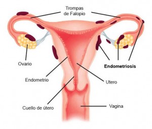 Centro ginecol&oacut Avisos gratis en Mexico lindo en Miguel Hidalgo |  Cl&iacute;nica de endometriosis profesional en ciudad de m&eacute;xico, Cl&iacute;nica de endometriosis en centro ginecol&oacute;gico
