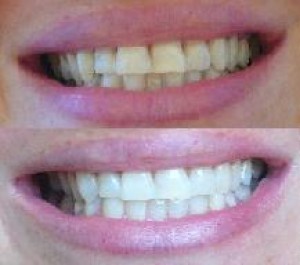  Avisos gratis en Mexico lindo en Benito Ju&aacute;rez |  CONSULTORIO DENTAL SAUCEDO, urgencias,amalgamas, resinas, porcelanas, blanqueamiento, cirugias, extracciones